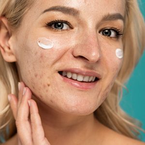 Woman with acne-prone skin applying gentle cleanser — ORY Skincare acne-prone skin facial cleanser for breakouts and redness.