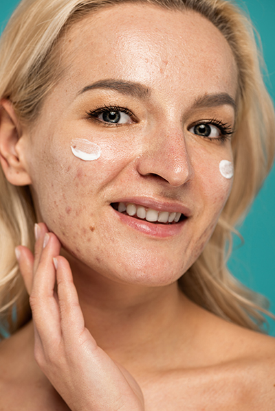 beauty_photoshoot_cleanser_acne-prone_skin Woman with acne-prone skin applying gentle cleanser — ORY Skincare acne-prone skin facial cleanser for breakouts and redness.
