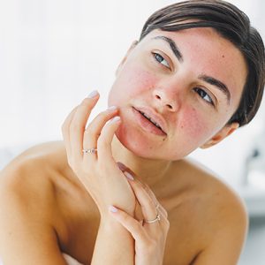 Woman with acne-prone skin applying soothing serum — ORY Skincare botanical serum for acne-prone complexions.